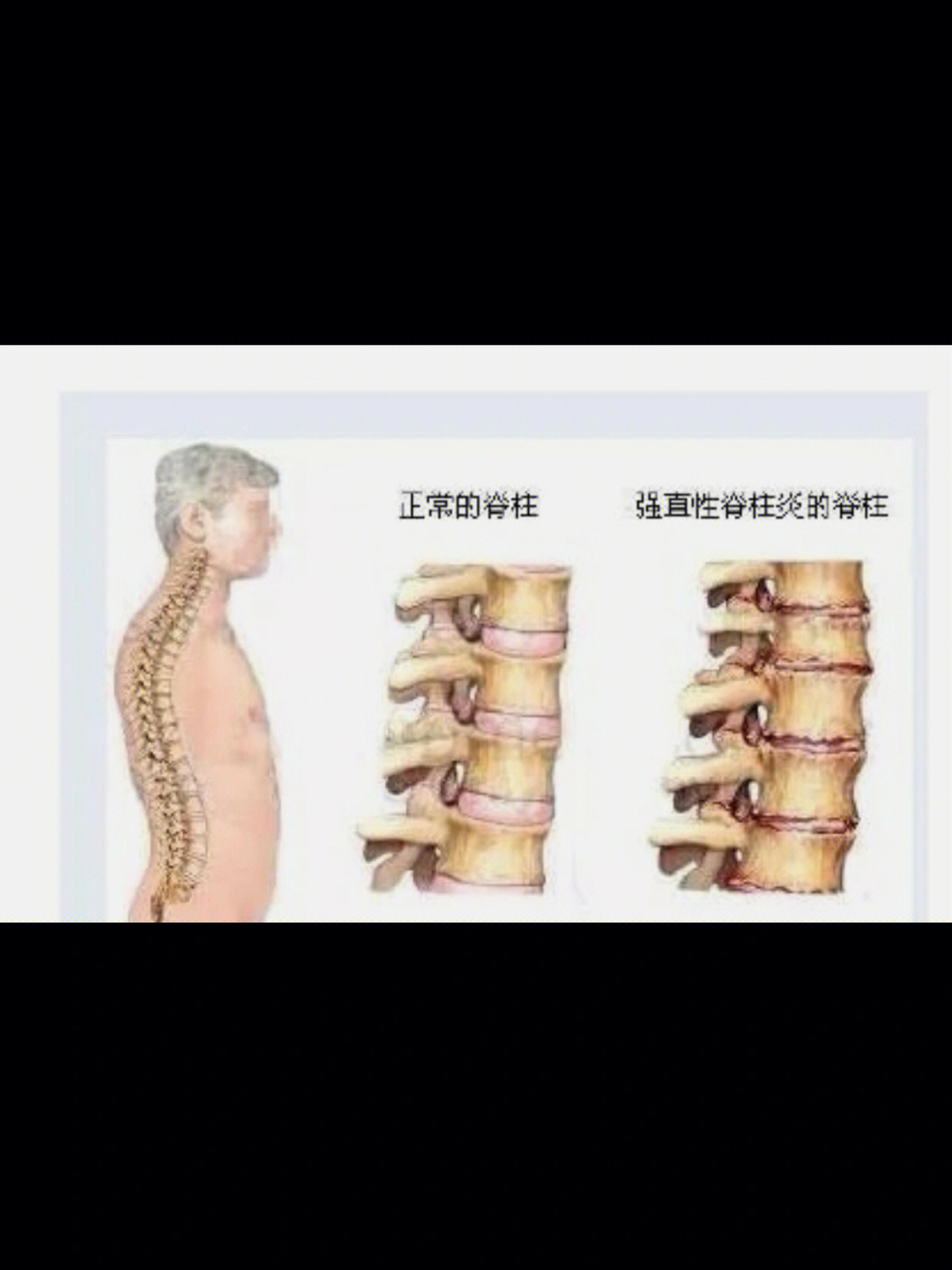 强直性脊柱炎护理查房与脊柱健康维护