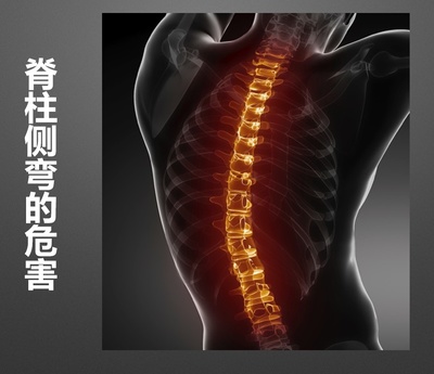 脊柱侧弯 悄然改变身姿，无声侵蚀健康
